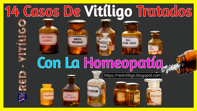 Tratamiento Homeopático del Vitiligo.