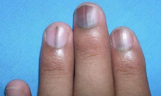 Το σημάδι στο νύχι που δεν πρέπει ποτέ να αγνοήσετε