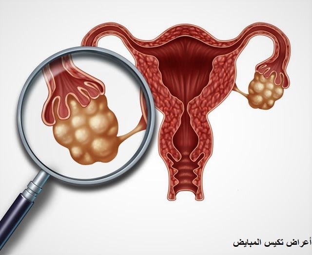 أعراض تكيس المبايض أعراض تكيس المبايض