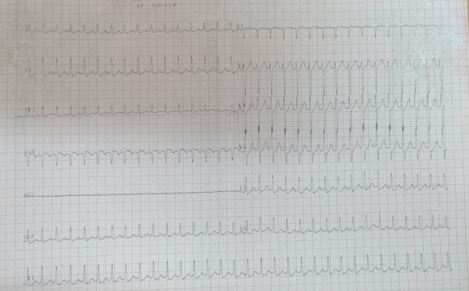 Cardiology window: PSVT