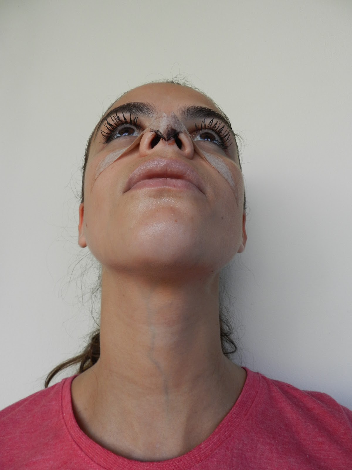 Rinoplastia Antes e Depois: Março 2013