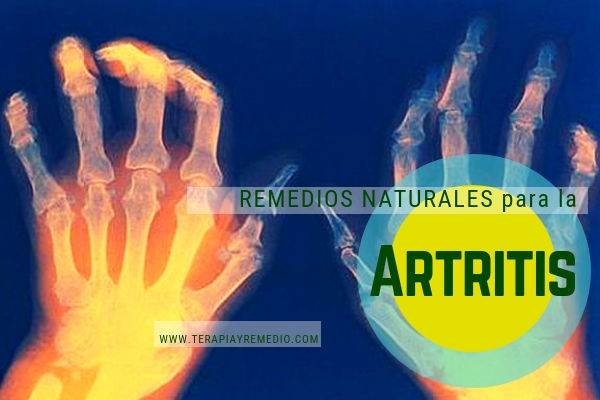 Remedios naturales para la artritis. Terapias alternativas para tratar el dolor articular