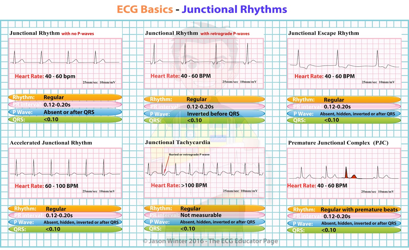 ECG Educator Blog Junctional Rhythms ecg-educator-blog-junctional-rhythms