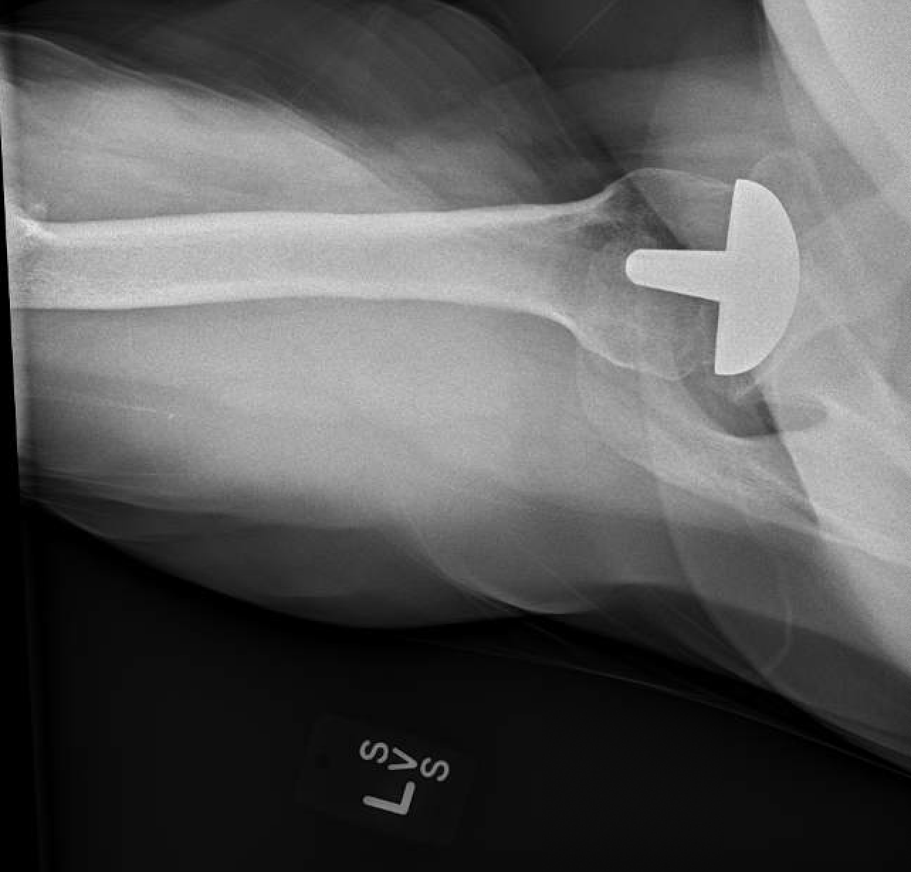 Shoulder and Elbow Surgery