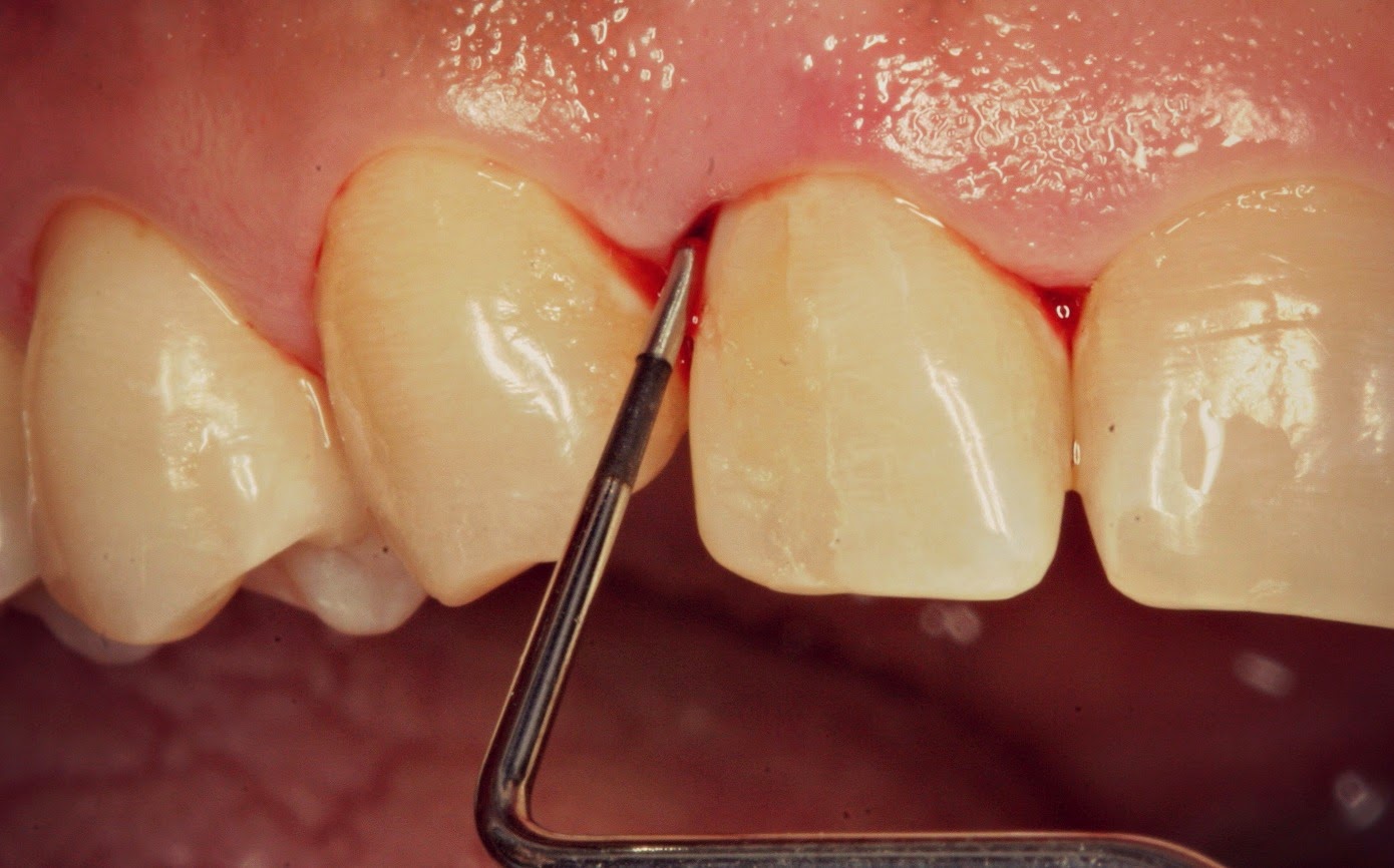 A Guide to Periodontology TOOTH GERM