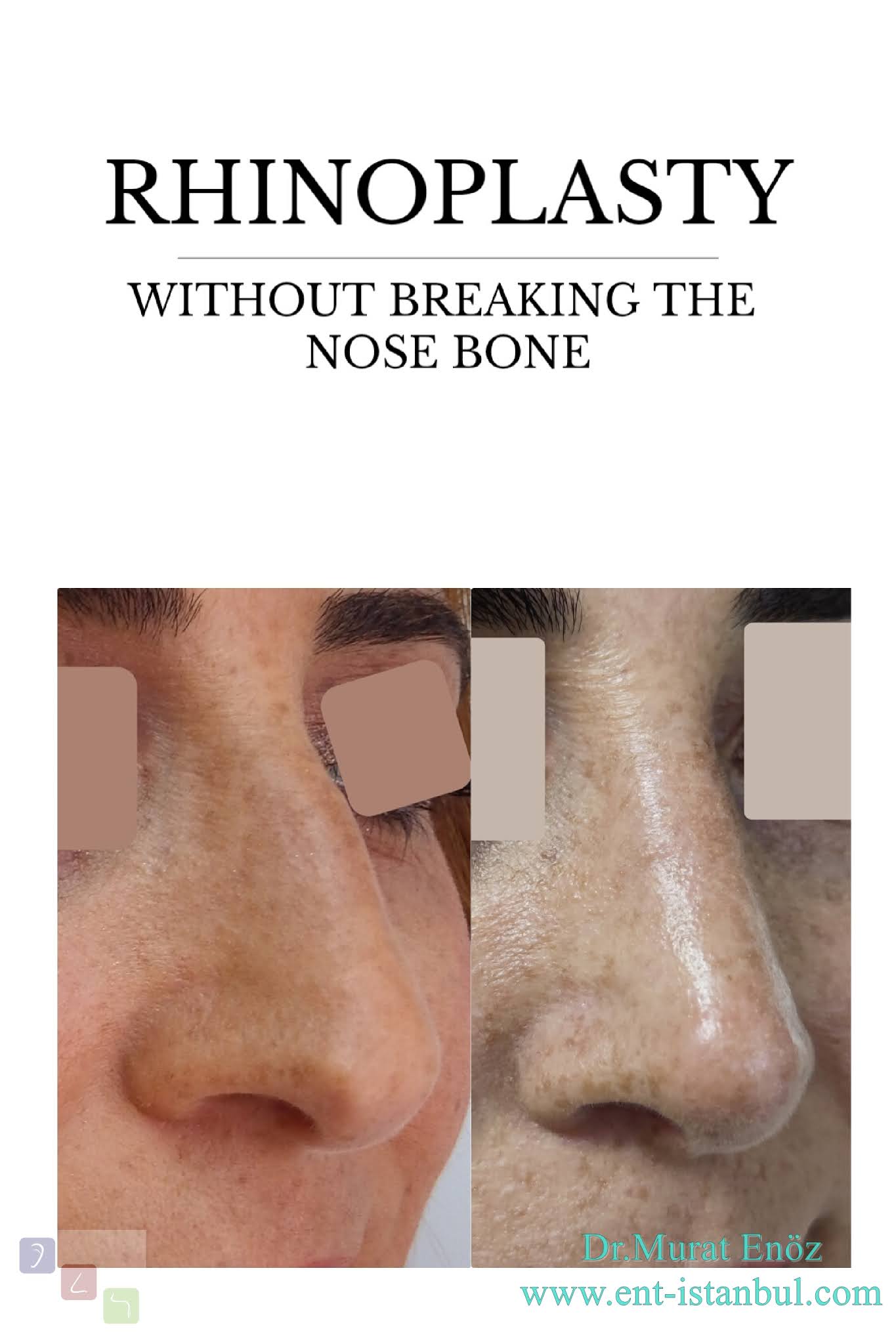 Rhinoplasty Operation Without Breaking The Nasal Bone