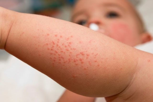 faktor penyebab alergi pada anak 