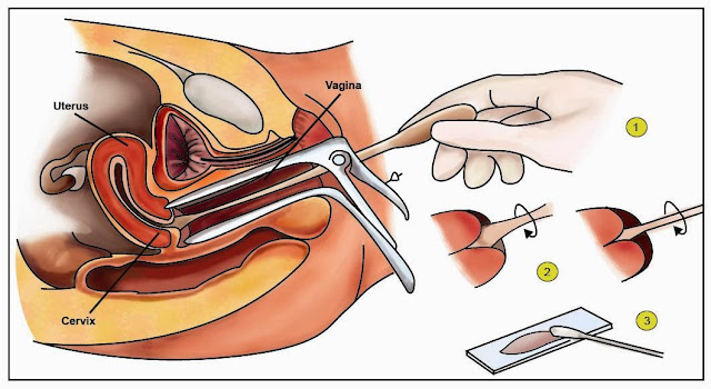 Pap Smear Procedure, Pap Smear 