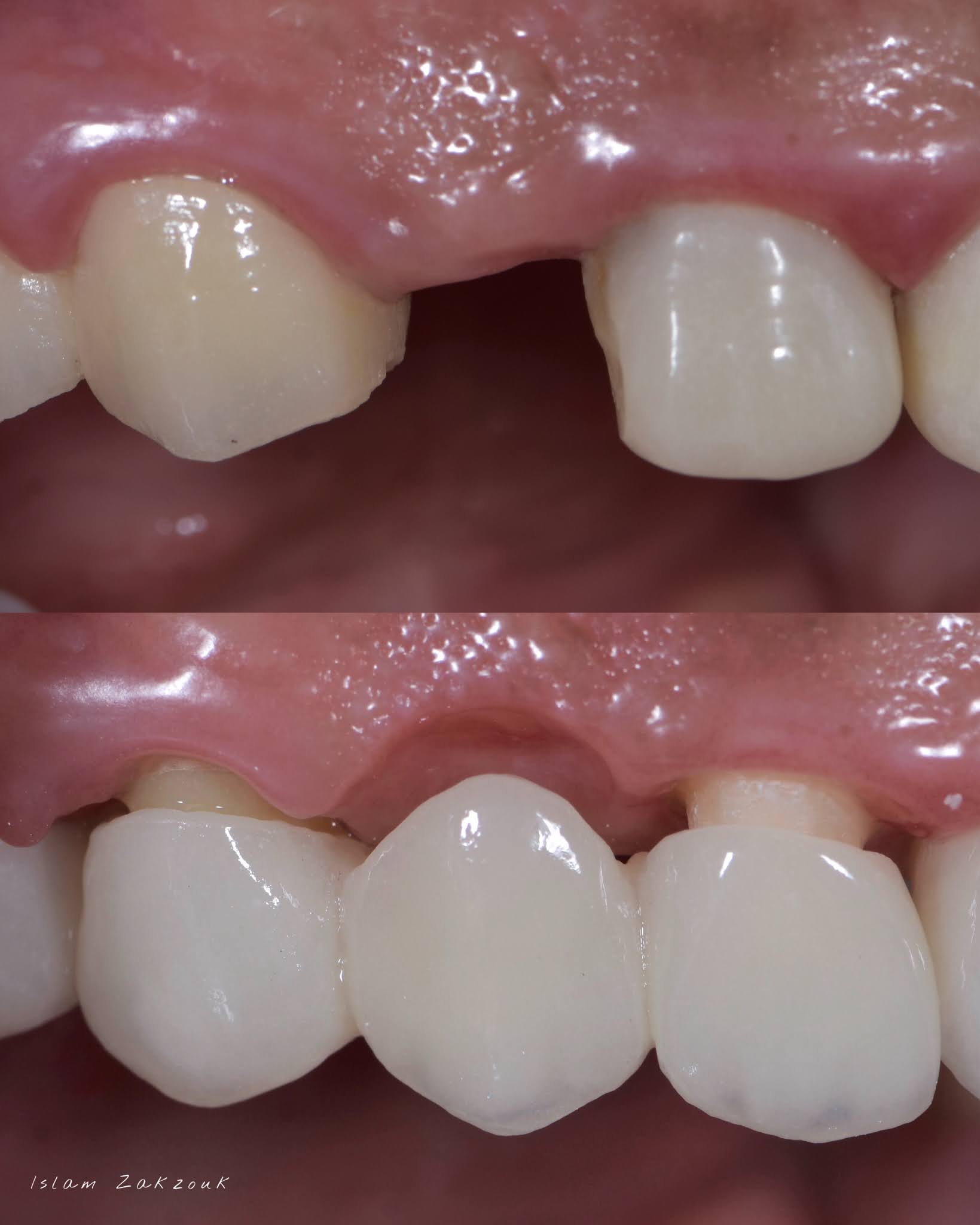 Ovate pontic for the correct emergence profile.. A clinical case Dental Esthetics
