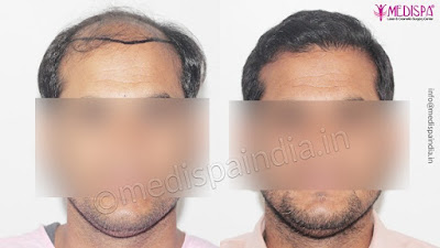 hair transplant in Delhi