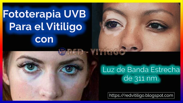 Fototerapia UVB Para el Vitiligo con Luz de Banda Estrecha de 311 nm