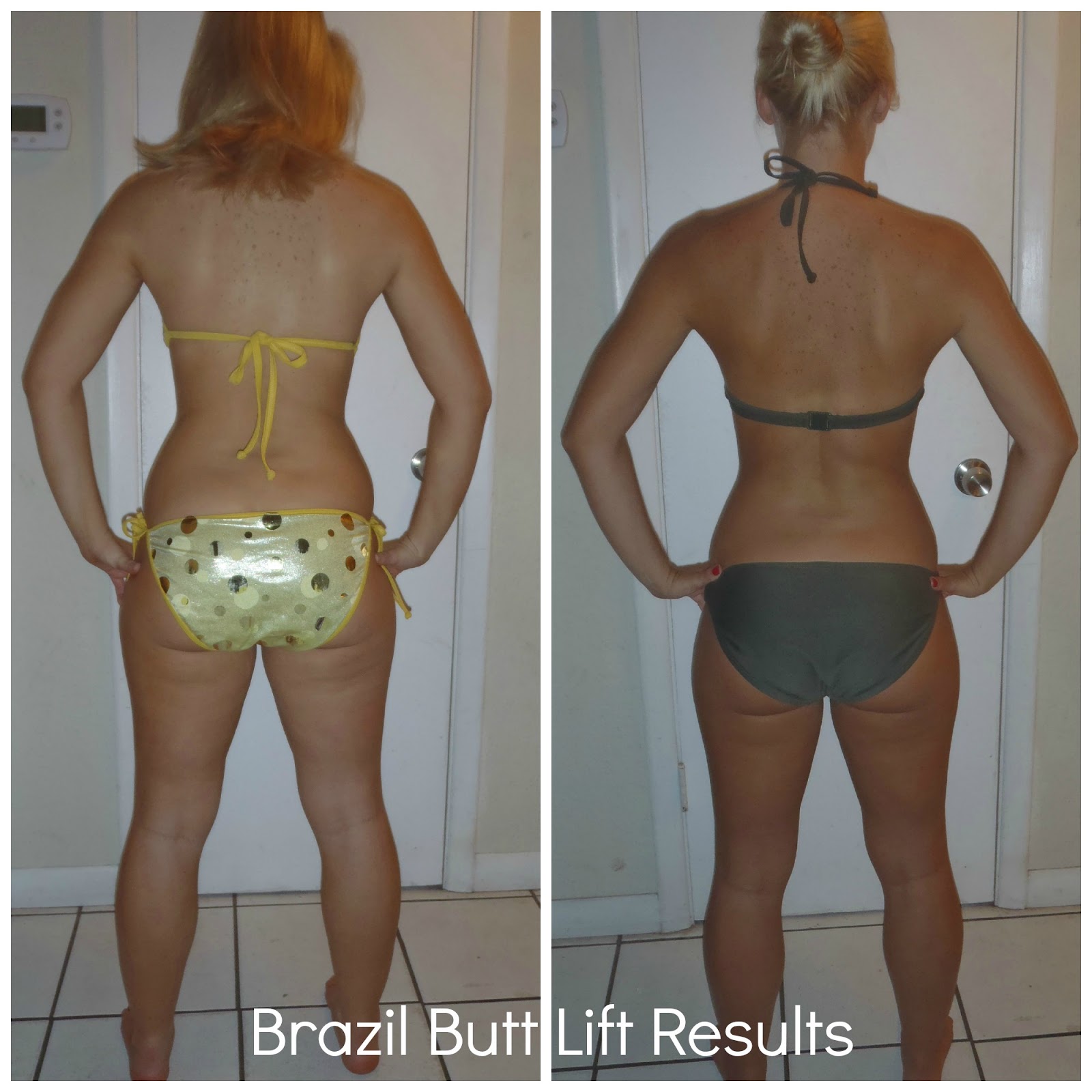 Brazilian Butt Lift Reviews 81