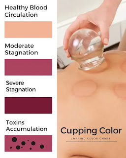 cupping color chart