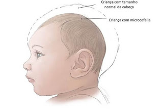 Microcefalia Cérebro menor