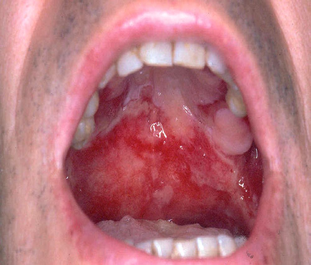 MEDICINA BUCAL Alergia a materiales y fármacos de uso estomatológico MEDICINA BUCAL Alergia a materiales y fármacos de uso estomatológico