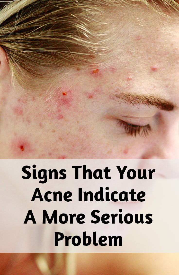 6 Acne Signs That Indicate More Serious Problems Health Fitness Detox