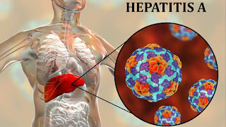 Hepatitis A overview 
