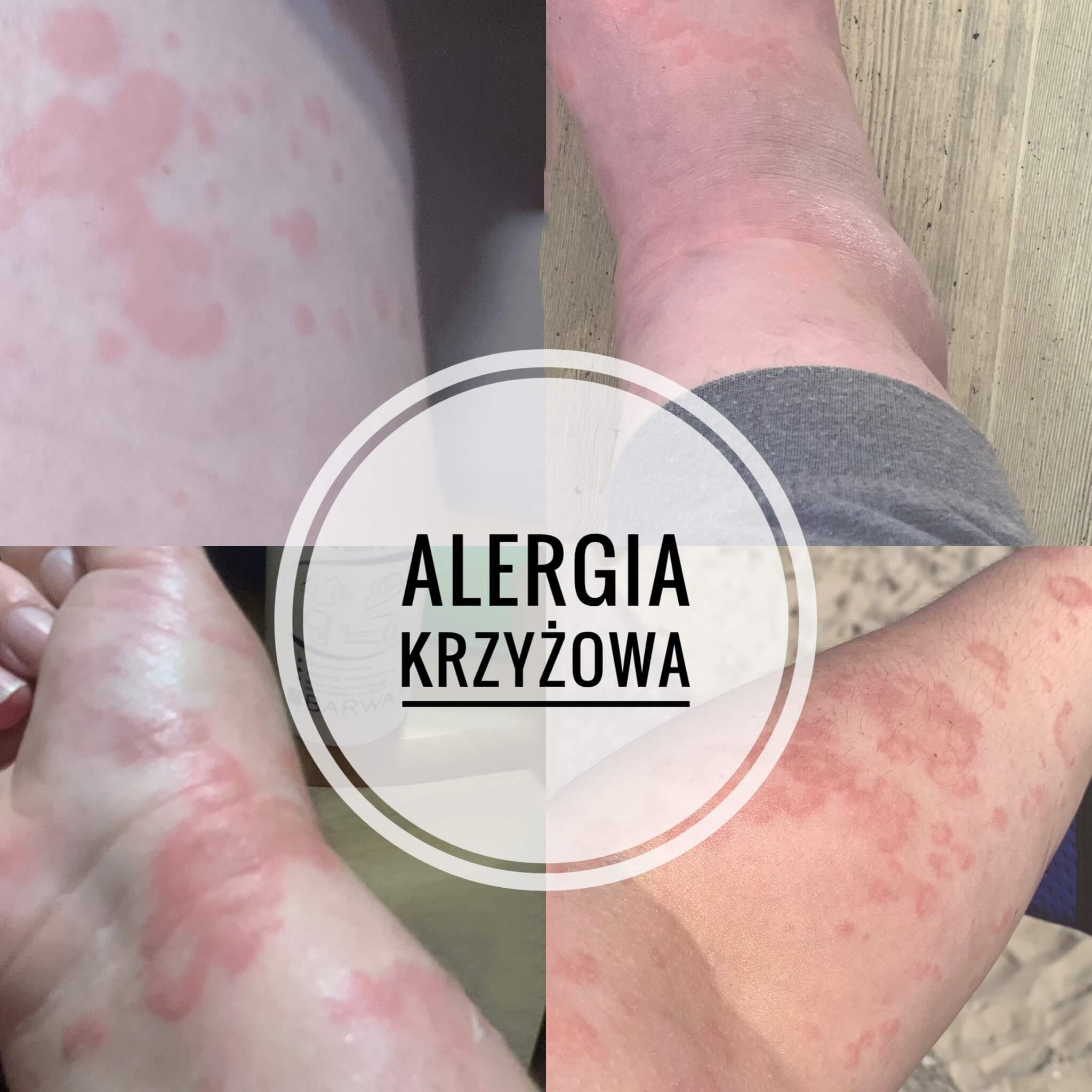 alergia-krzyżowa jak-wygląda-alergia-krzyżowa