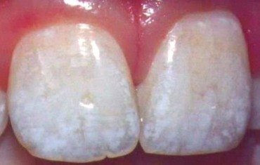 Khắc phục răng nhiễm màu nặng an toàn hiệu quả-2