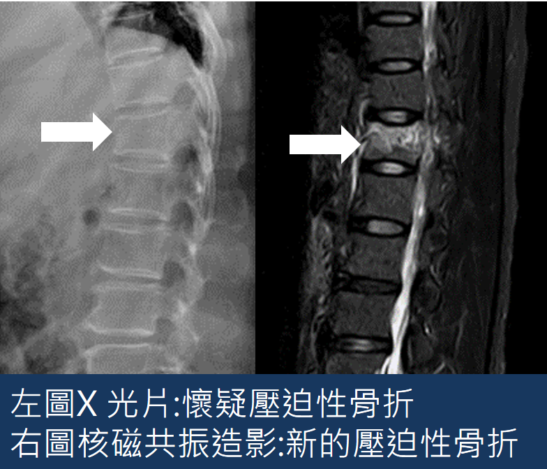 Mr Shih 施育彤醫師 壓迫性骨折怎麼辦 脊椎骨灌骨漿手術
