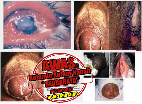 Cara Pengobatan Alternatif Kencing Nanah Tanpa Ke Apotik Cara Pengobatan Alternatif Kencing Nanah Tanpa Ke Apotik