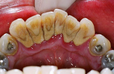 Bảng giá bọc răng sứ cho răng sâu