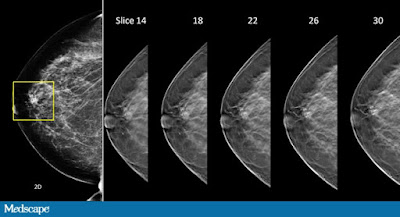 Breast Imaging Market 