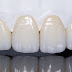 Bọc răng sứ không cần mài răng áp dụng khi nào?