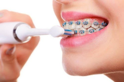 Lỗi kỹ thuật niềng răng bị sưng lợi bạn cần đề phòng 1