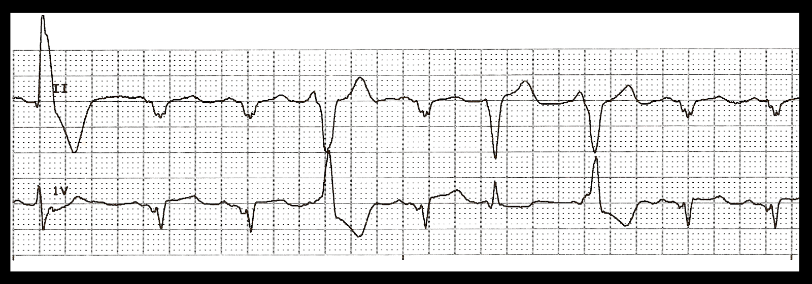 Various Rhythms with Multifocal PVCs