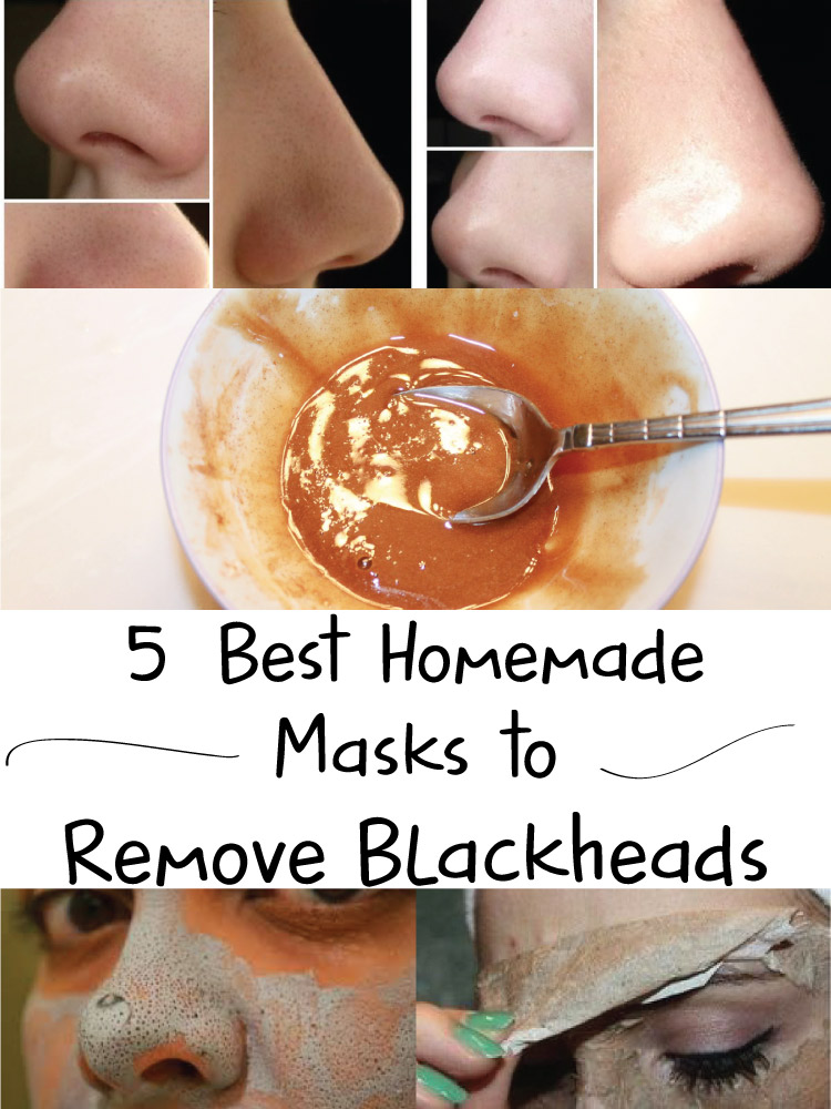 5 Best Homemade Masks to Remove Blackheads Fit DB