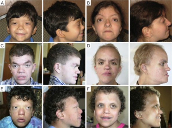 Legius Syndrome