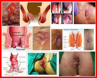 Cara Herbal Alami Paling Ampuh Mengatasi Wasir Luar