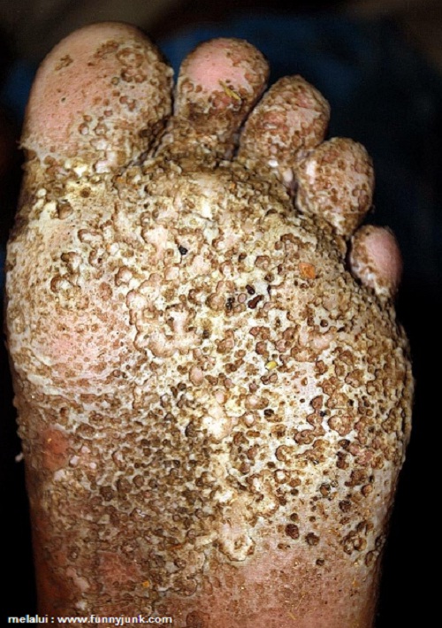 Penyakit kulit eksim, gejala & penyebabnya Penyakit Kulit Berlubang Pitted Keratolysis, Penyebab & Cara Mengatasi