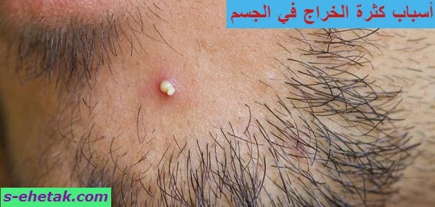 أسباب كثرة الخراج في الجسم أسباب كثرة الخراج في الجسم