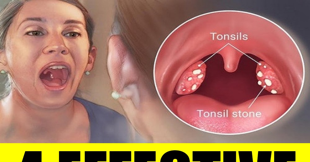 4 EFFECTIVE WAYS TO REMOVE TONSIL STONES WITHOUT SURGERY