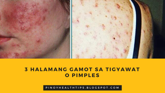 3 Halamang Gamot sa Tigyawat o Pimples