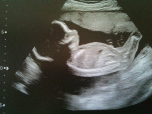 20 week pregnancy scan