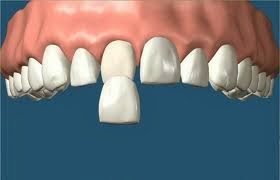 http://www.dentistinchennai.com/porcelain-veneers.php