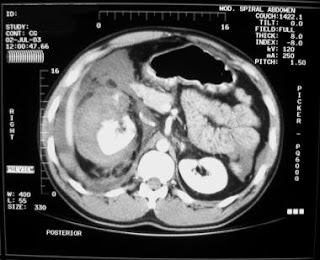 Blunt injury abdomen dissertation