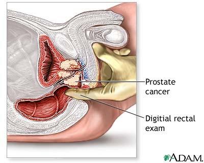 ce este prostata definitie