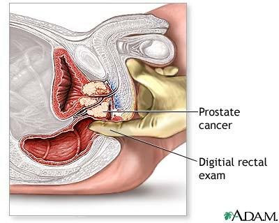 boala rectală și prostatita