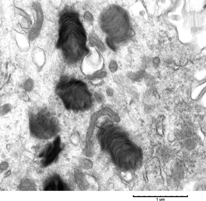 When You See Zebra Bodies…Think Commonly Prescribed Medications