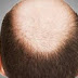 Bald men more at risk to contract serious coronavirus symptoms