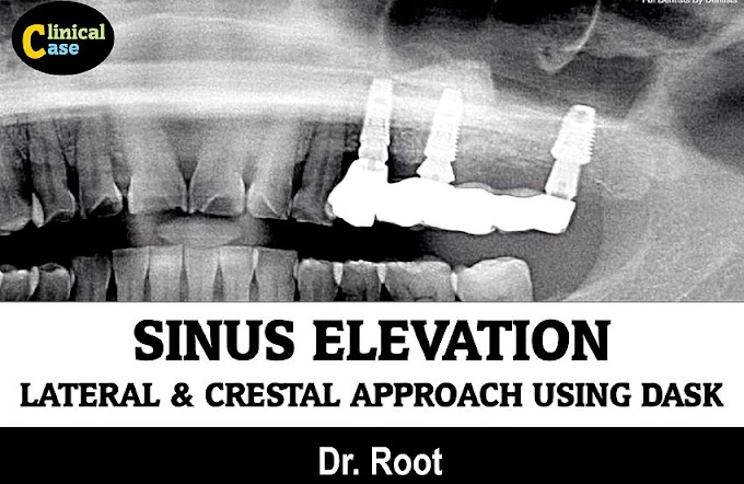 SINUS ELEVATION: Lateral & Crestal approach using DASK - Dr. Root