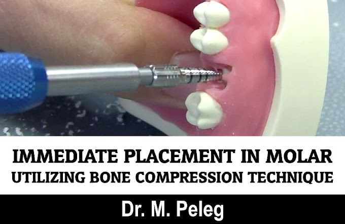 IMMEDIATE DENTAL IMPLANT: Immediate placement in molar site utilizing bone compression technique - Dr. M. Peleg