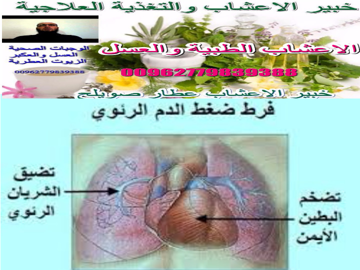 فرط ضغط الدم الرئوي أو ارتفاع ضغط الدم الرئوي امراض القلب والاعشاب