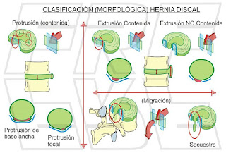Clasificación morfológica hernia discal.