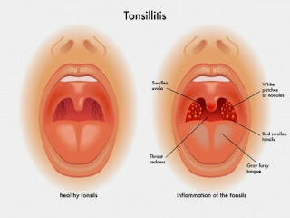 Tonsillitis and tonsillectomy post operative care plan 1