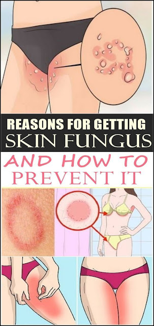 Reasons For Getting Skin Fungus And How To Prevent It
